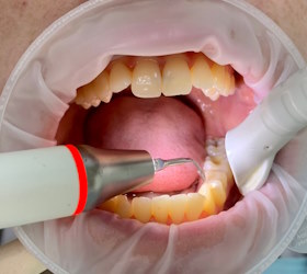 Ультразвуковое снятие зубного камня